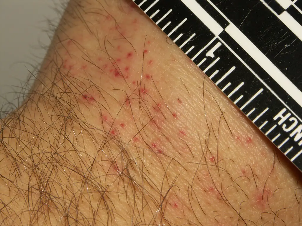 What Do Bed Bugs Bites Look Like Pictures Of Bed Bug Bites